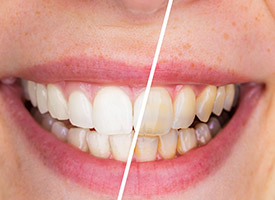 yellow teeth before and white teeth after