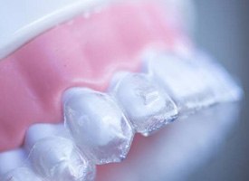 Clear aligner on dental mold