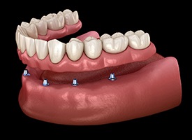 digital model of All-On-4 lower denture.