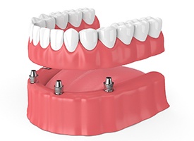 Computer model of denture and 4 dental implants.
