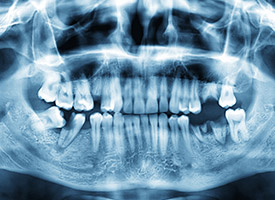 x-ray of whole mouth