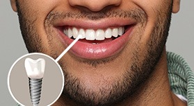 Nose-to-chin view of man smiling with one tooth indicated as implant