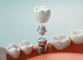 the three parts of a dental implant