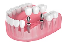 dental implant with crown in the upper jaw 