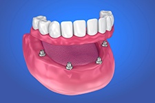 two dental implants with a bridge 