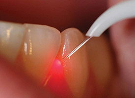 soft tissue laser being used on tooth