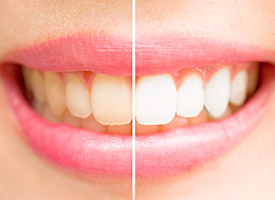 teeth before and after teeth whitening