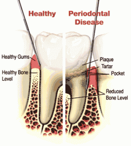 gum disease