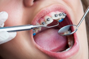 When crooked teeth threaten dental health and self-image, seek an evaluation from a Canton, MI orthodontist. Learn steps to finding the right one for you. 