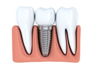 Learn more about dental implants in Canton, MI and how they can restore your smile.