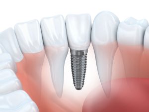 The dentist in Canton provides comprehensive implant care. 