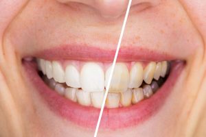 Smile before/after teeth whitening