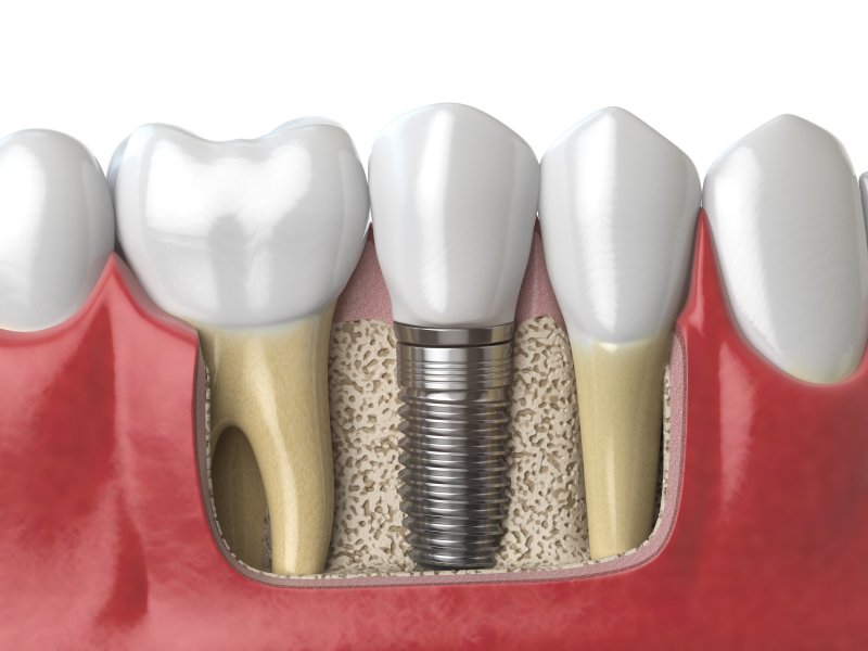 Illustration of dental implants in Canton