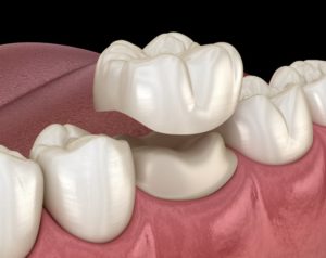 dental crown from dentist in Canton