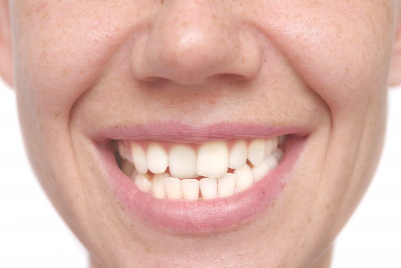 A woman whose teeth have shifted