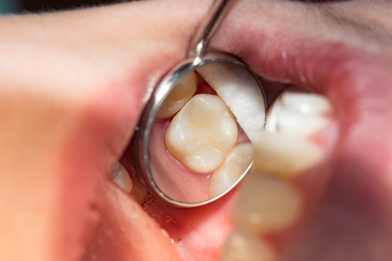 close-up of a dental filling