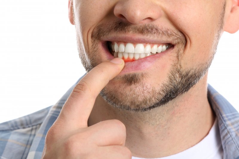A man revealing his gum disease