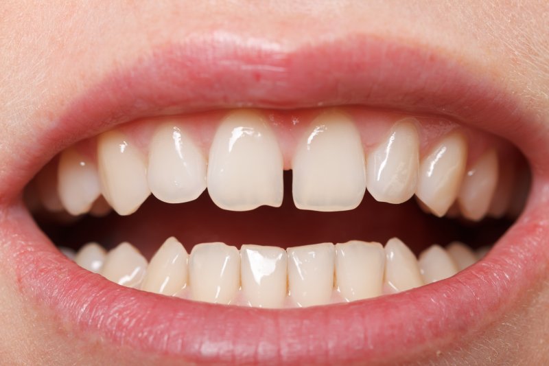 A closeup of a gap between two front teeth